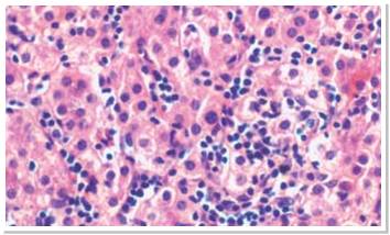 Hepatosplenic T-Cell Lymphoma (HSTCL)