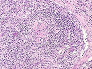 Angioimmunoblastic T-cell Lymphoma